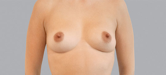 STEMFORM<sup>TM</sup> Natural Breast Augmentation